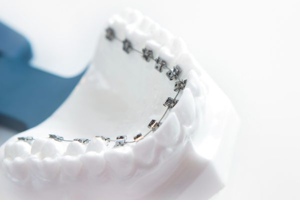 Lingual brackets