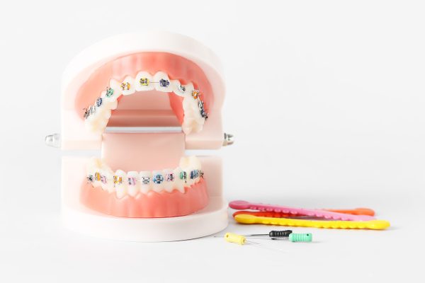 Fixed braces